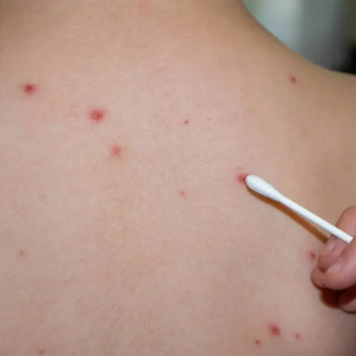 Crește numărul cazurilor de rujeolă la Spitalul de Copii "Sf. Maria" din Iași