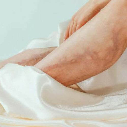 Avertismentul medicilor despre semnele afecțiunilor venoase și arteriale