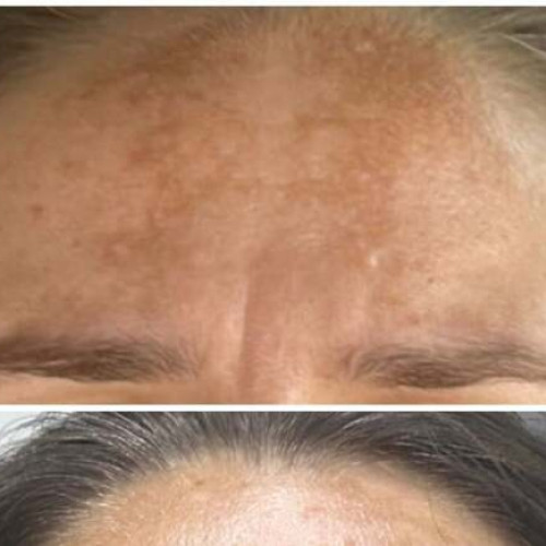 Melasma, o afecțiune comună a pielii, afectează în special femeile