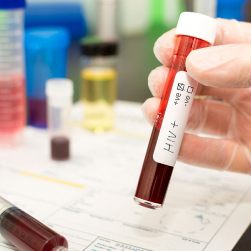 Situația sănătății publice la Brăila: creștere a cazurilor de HIV/SIDA și TBC