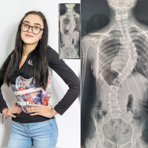 O adolescentă din Brăila are nevoie de ajutor pentru a lupta împotriva unei afecțiuni grave. Potrivit unui articol de pe site-ul obiectivbr.ro, Miruna, în vârstă de 17 ani și elevă la Colegiul Pedagogic din Brăila, trebuie să suporte o operație costisitoare de 140.000 de lei, sumă aproape imposibil de strâns pentru familia sa.