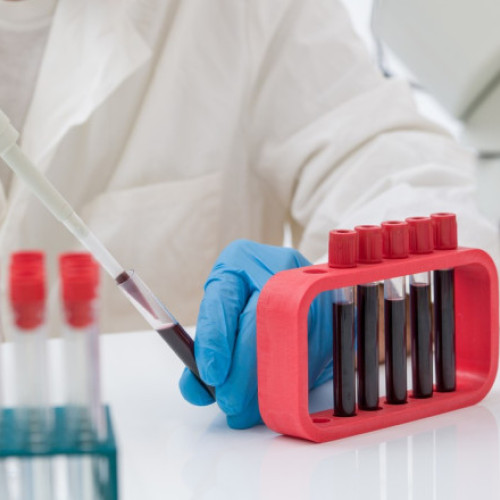 Un test de sânge ar putea detecta prezența mutațiilor maligne cu 3 ani înainte de apariția primelor simptome de cancer, arată un studiu