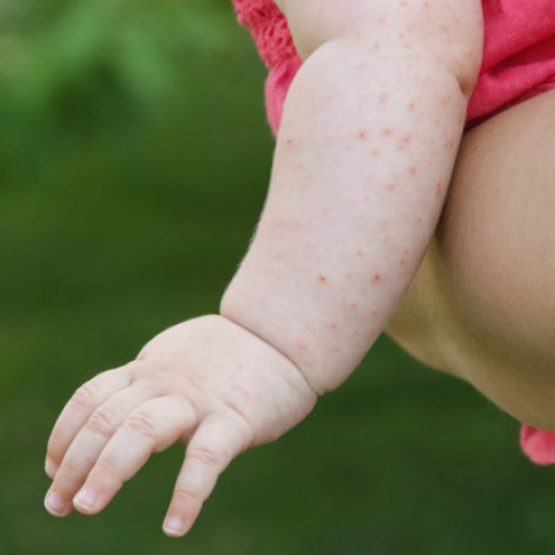 SUA se confruntă cu cea mai gravă epidemie de rujeolă din secolul XXI. Secretarul de stat Robert Kennedy Jr., acuzat că o alimentează