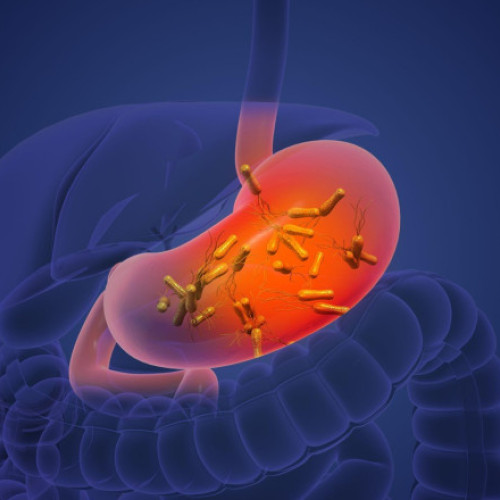 Bacteria Helicobacter Pylori ar putea provoca milioane de cazuri de cancer de stomac în următorii ani (studiu)