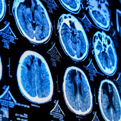 Pandemia de COVID-19 a accelerat îmbătrânirea creierului, chiar și fără transmitere infecțioasă