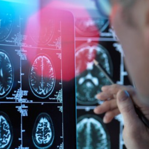 Un medicament pentru tratarea bolii Alzheimer în stadii timpurii este aproape de autorizare în UE. Ce este donanemab