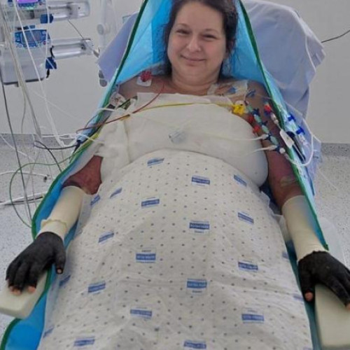 Care este starea Laviniei, pacienta cu arsuri infectată la Floreasca și transferată în Belgia. Anunţul surorii sale: „Rămâne un mister”