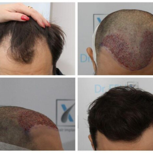 rezultate naturale și durabile cu implantul de păr la clinica dr. felix hair implant