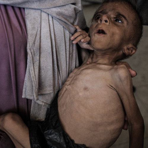 Criză alimentară în Gaza: mii de copii sub cinci ani în programe de recuperare