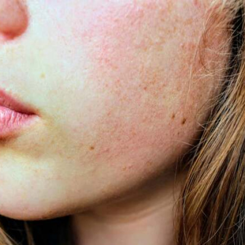 Dermatita atopică: factori de risc și impactul mediului