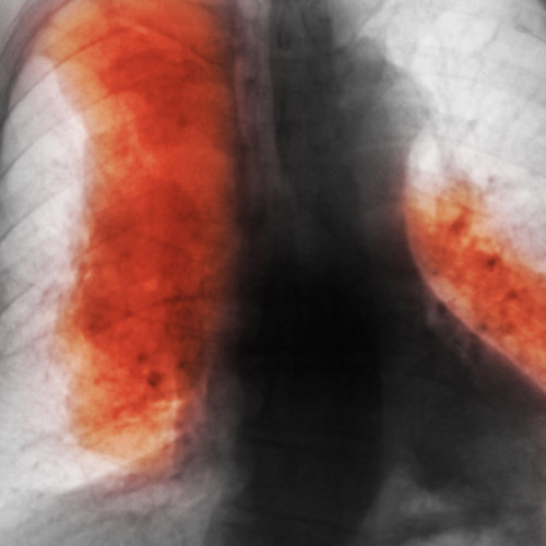 Decesele cauzate de cancer ar putea depăși 18,5 milioane anual până în 2050