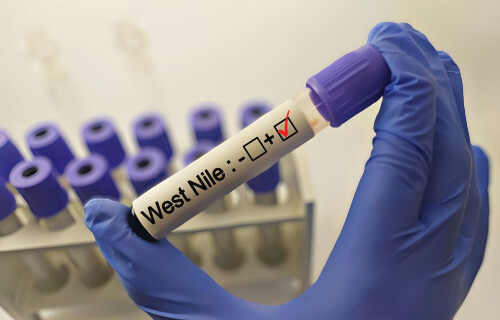 Cinci cazuri de meningită cauzate de virusul West Nile confirmate în Brăila