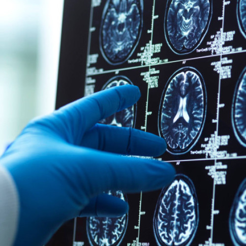 Creierul bărbaților se micșorează mai rapid, dar Alzheimerul afectează mai mult femeile