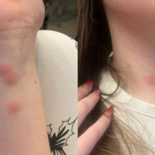 Tânără mușcată de ploșnițe în tren pe ruta București-Sighet