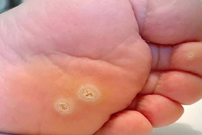 Verucile plantare pot deveni dureroase și se transmit ușor în spațiile umede publice