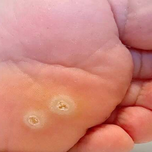 Verucile plantare pot deveni dureroase și se transmit ușor în spațiile umede publice