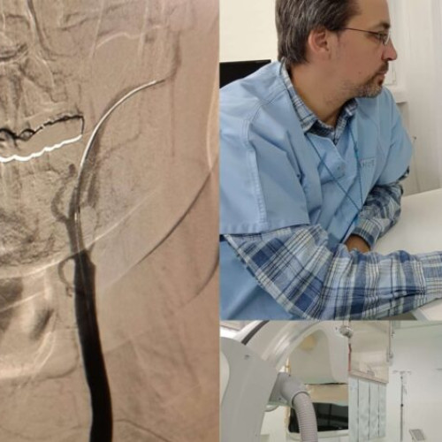 Spitalul Județean Buzău a realizat primele angioplastii carotidiene și subclavii