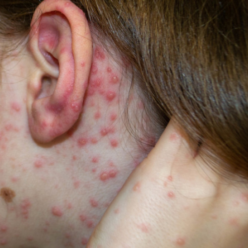 Rujeola reapare în Europa din cauza scăderii vaccinării copiilor