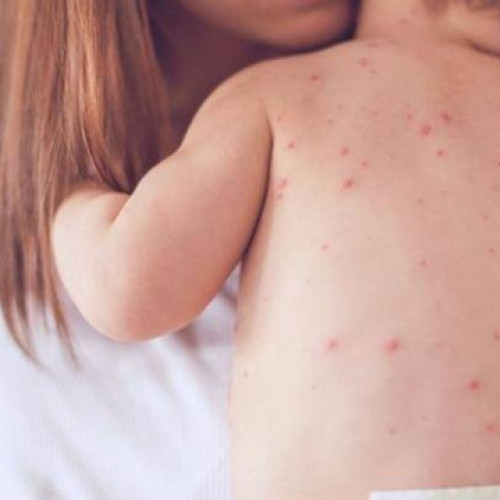 OMS avertizează asupra reapariției focarelor de rujeolă în Europa și România