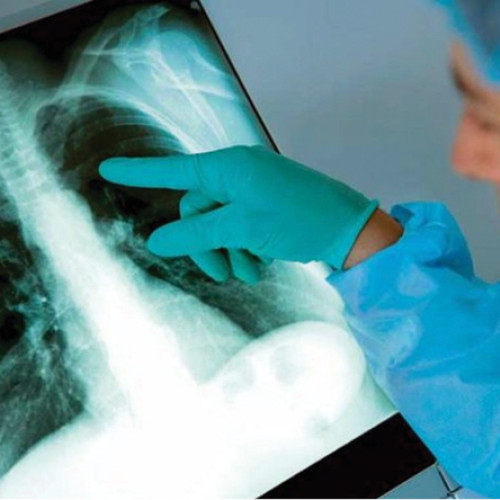 Un studiu inovator testează imunizarea preventivă pentru cancerul pulmonar